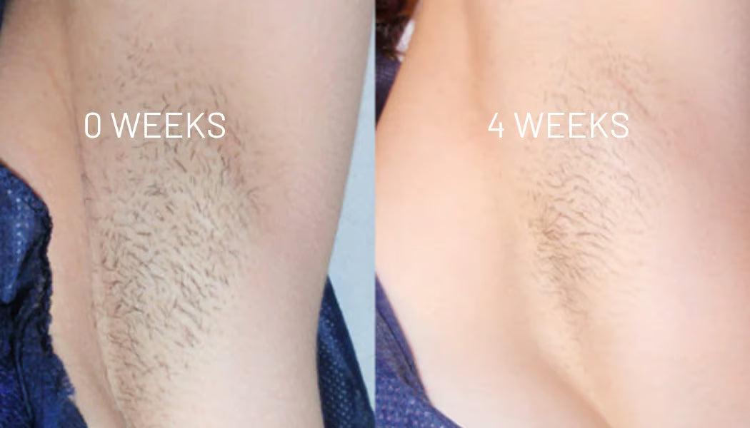 Anti haargroei olie - Effectiever dan laseren!