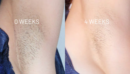 Anti haargroei olie - Effectiever dan laseren!