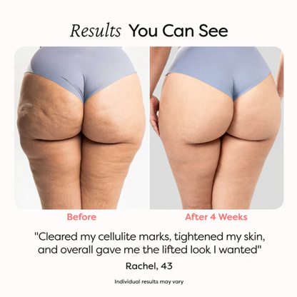 Anti-Cellulitis Roller - De salon behandeling voor thuis