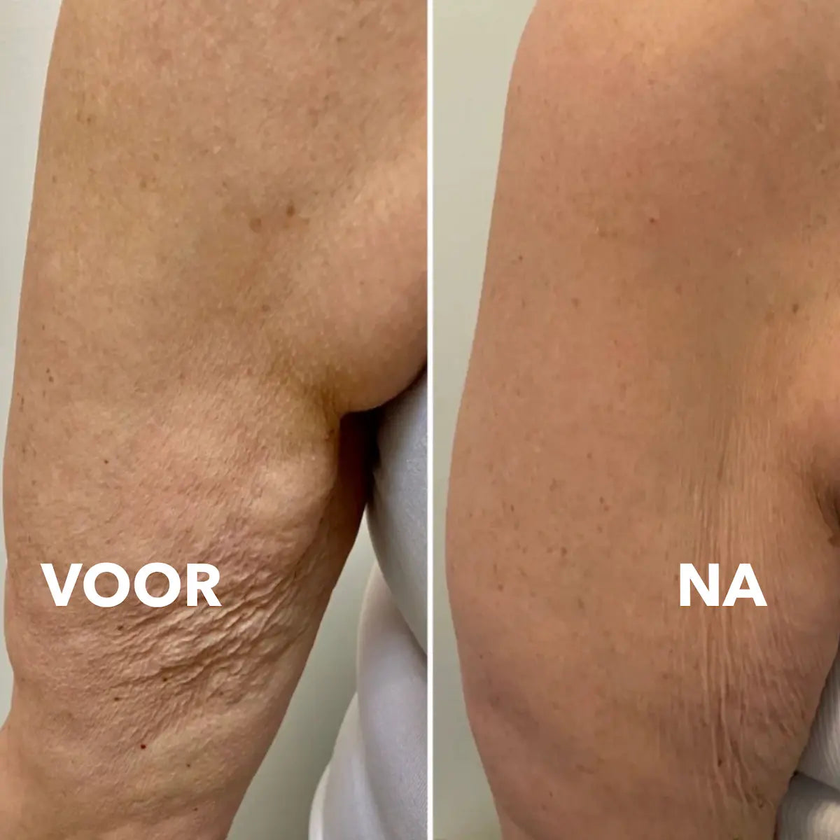 VelvetLift™ | De sticker die de huid in één keer glad strijkt (10 Stuks)