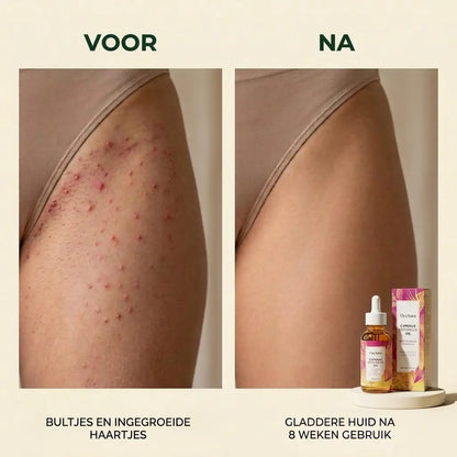 Anti haargroei olie - Effectiever dan laseren!